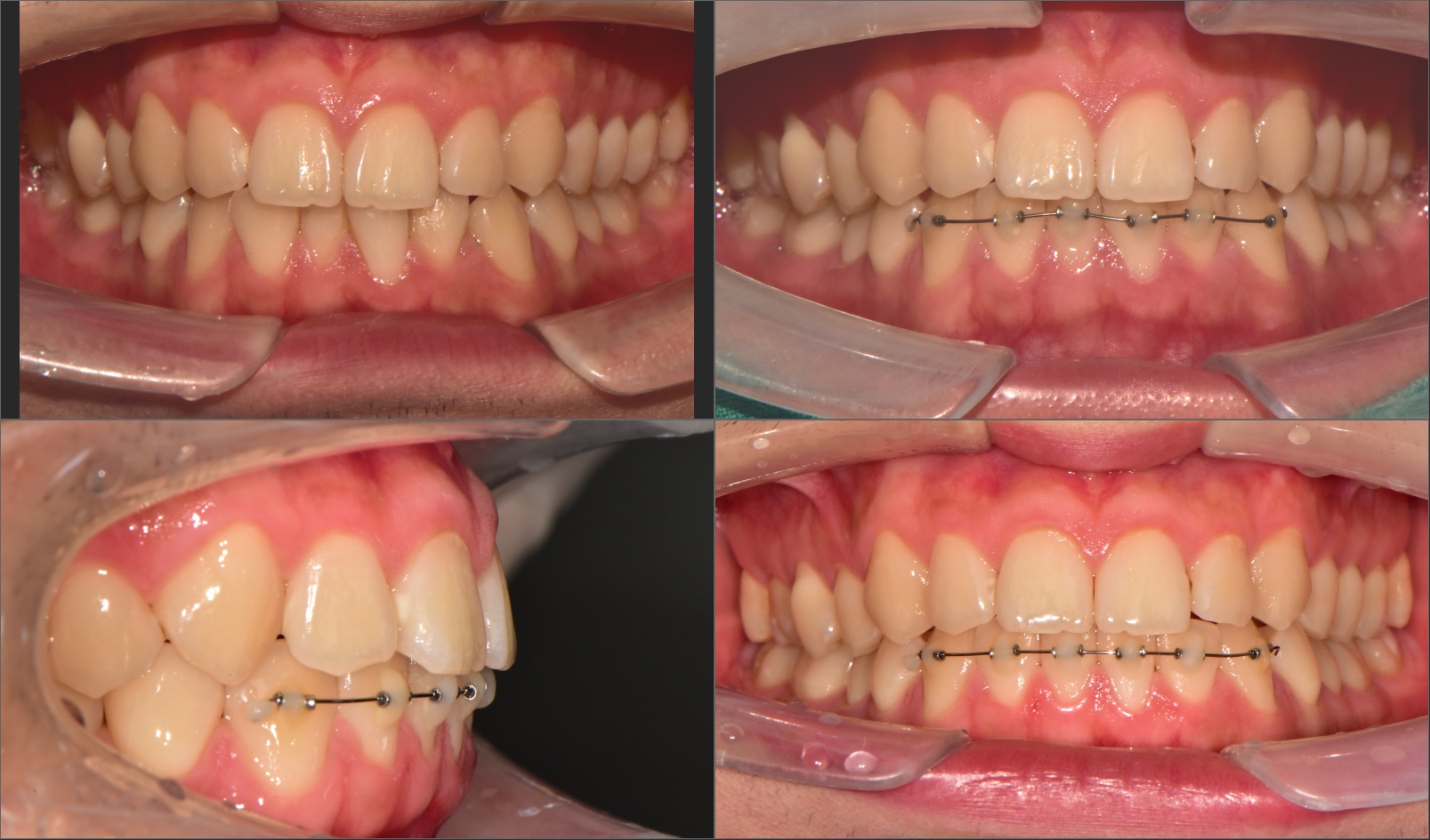 베스트치과 임상 증례 - 부분교정 1